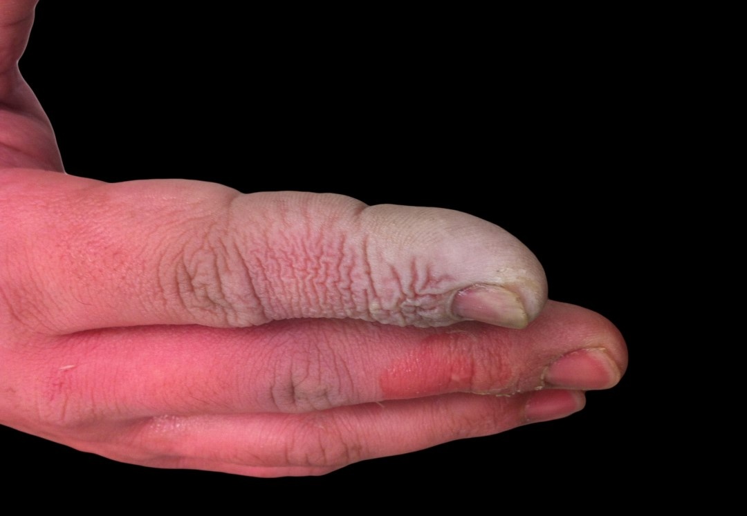 接触了氢氟酸的手部